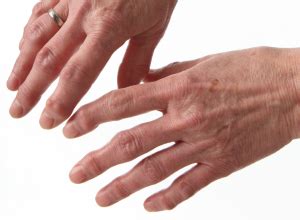 Image result for How to Get Rid of Hererdens Nodes