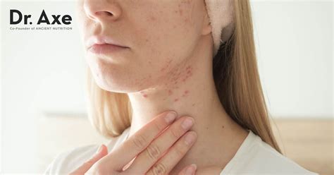 Inside Nodule Acne に対する画像結果