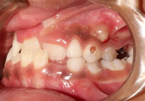 Image result for Maxillary Protraction