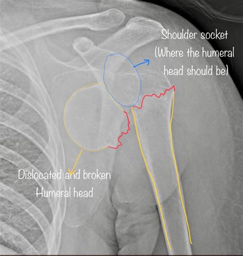 Image result for Proximal Humerus Fracture Protocol