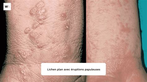 Image result for Lichen Ellebogen