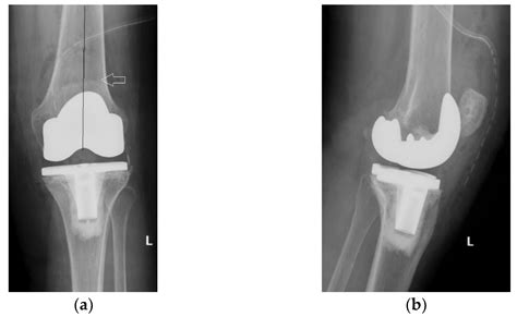 Image result for PF Joint-Replacement