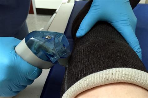 Image result for Cast Removal 2021