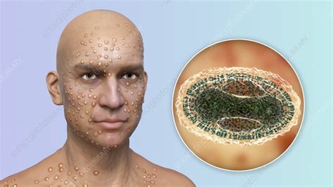 What Does Smallpox Look Like に対する画像結果