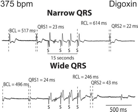 Image result for Digoxin Pulse Waveform