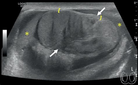 Image result for Exploding Testikals