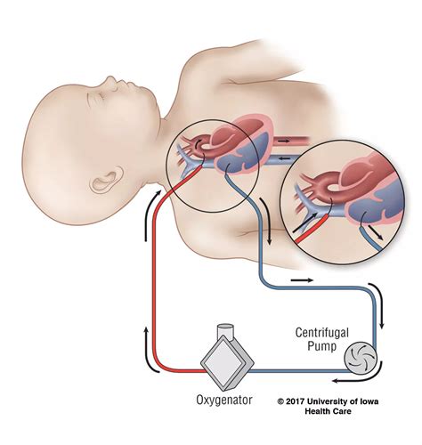 Image result for ECMO Meaning