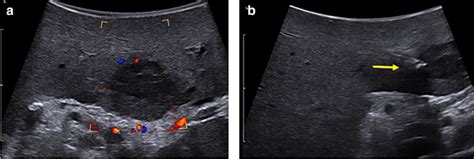 Image result for Compressed Ultrasound Procedure