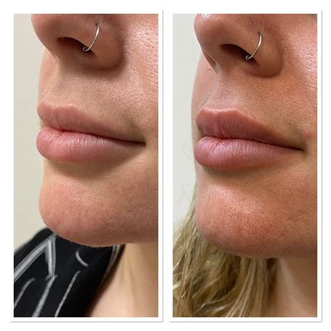 Image result for Lip Flip Botox Injections