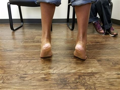 Image result for Pes Planovalgus