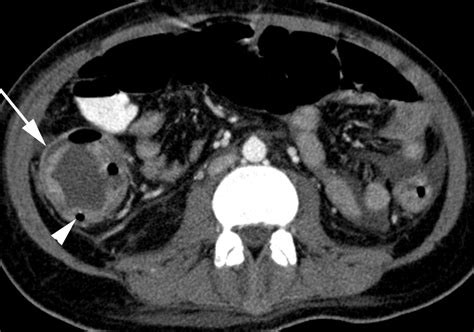 Image result for Ulcerative Colitis CT Scan