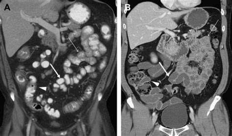 Image result for CT Enterography