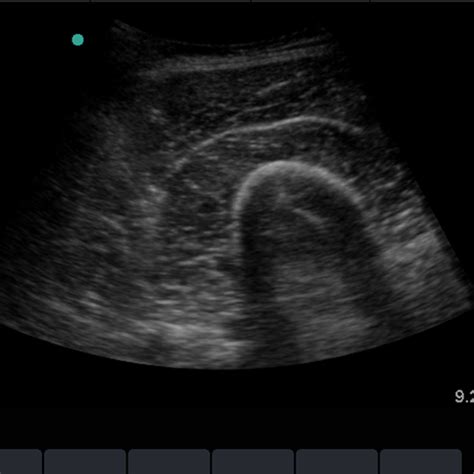 Image result for What Is a Soft Tissue Ultrasound