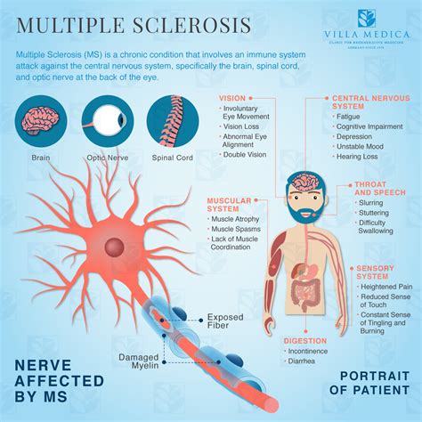 Image result for Multiple Sclerosis Graphics