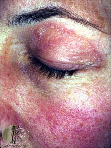 Toradh íomhá ar Dermatomyositis in Children