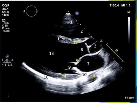 Watchman Parasternal Long Axis に対する画像結果