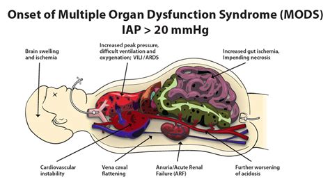 Image result for Multiple Organ Dysfunction Syndrome