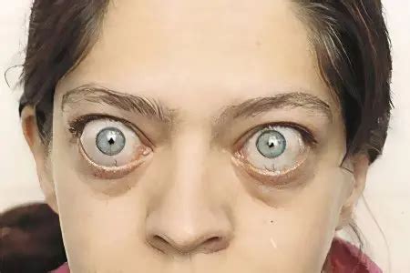 Image result for Exopthalmia