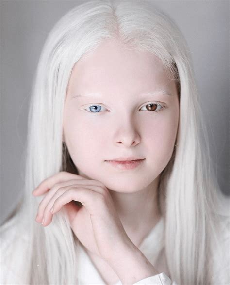 Light Blue Eyes Albinism に対する画像結果