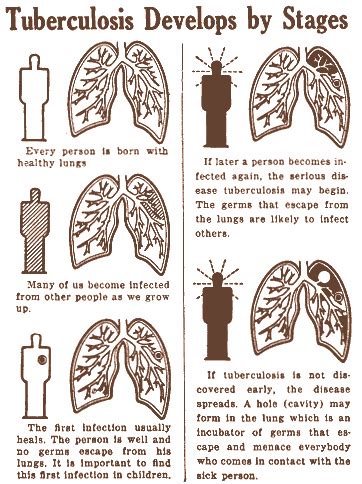 Image result for Tuberculosis Latent Stage