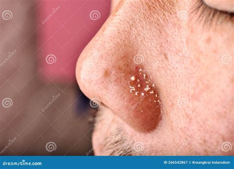 Image result for Closed Comedones Nose Nose