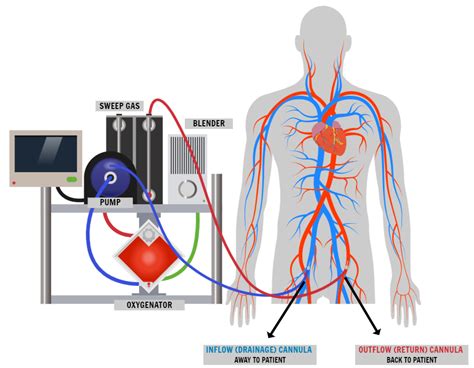 Image result for How Does ECMO Work