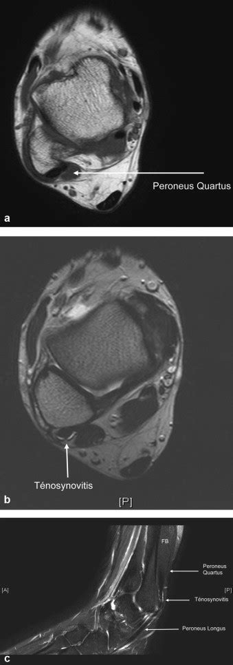 Peroneus Quartus Muscle に対する画像結果