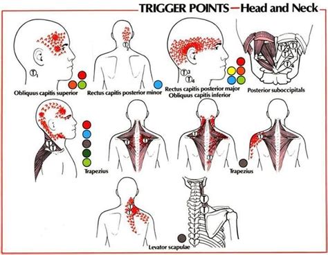 Image result for Trigger Points of Upper Back and Neck