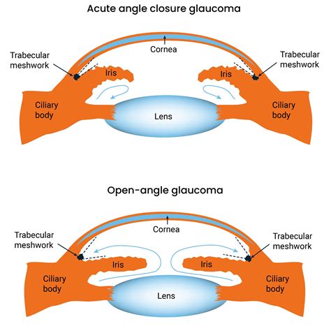 Afbeeldingsresultaten voor What Is Acute Angle