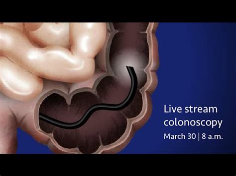 Image result for Colonoscopy Procedure Live