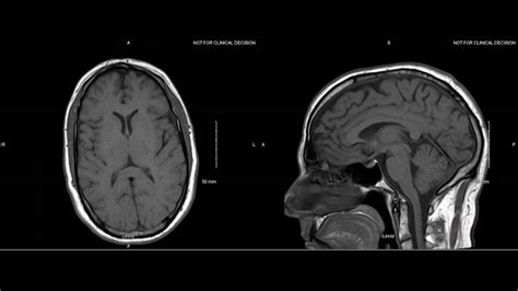 Normal Brain Mri With Contrast Images Radiologia