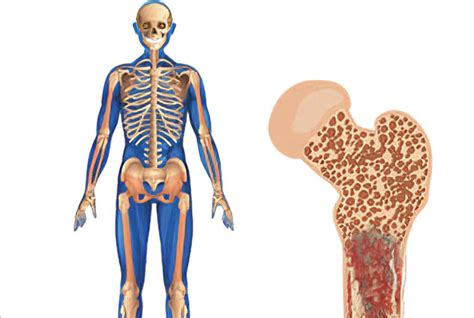 Image result for Bone Cancer Tumor