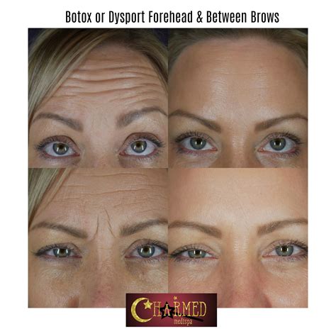Image result for Glabella Botox