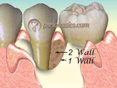 Image result for Abnormal Wall Defects Classification