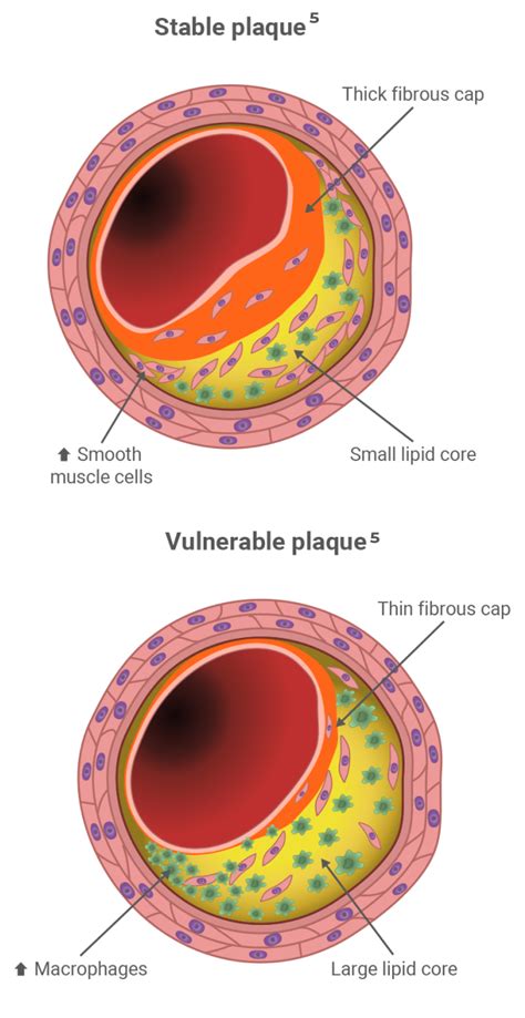 Image result for Plaque Distribution Moderate Diffuse