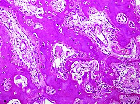 Image result for Osteoma Resection