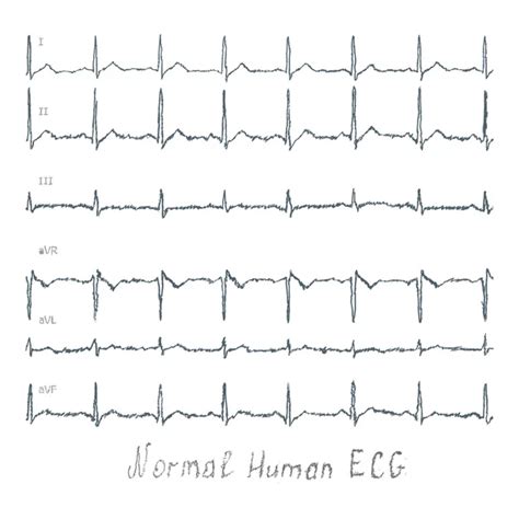 Image result for Normal EcG
