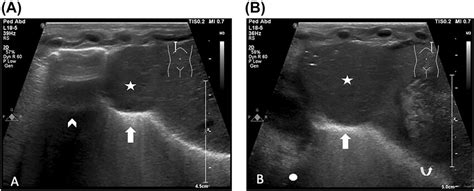 Toradh íomhá ar Hemi Diaphragmatic Eventration