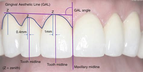 Marginal Gingival に対する画像結果