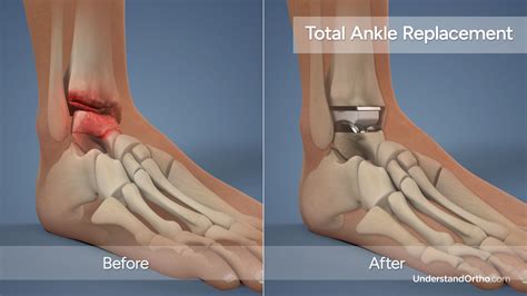 Image result for Ankle Replacement