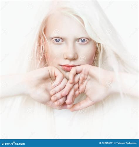 Light Blue Eyes Albinism に対する画像結果