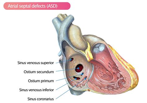 Toradh íomhá ar Atrial Septal Defect Classification