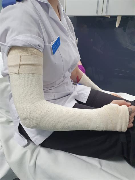 Image result for Splitting Elbow Cast