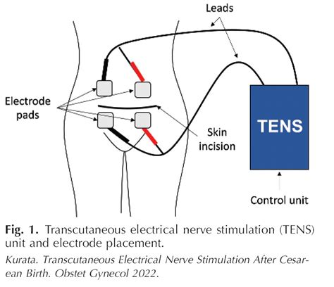Transcutaneous Electrical Stimulation-এর ছবি ফলাফল