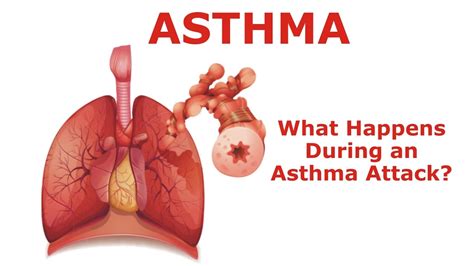 Image result for What Happens during an Asthma Attack