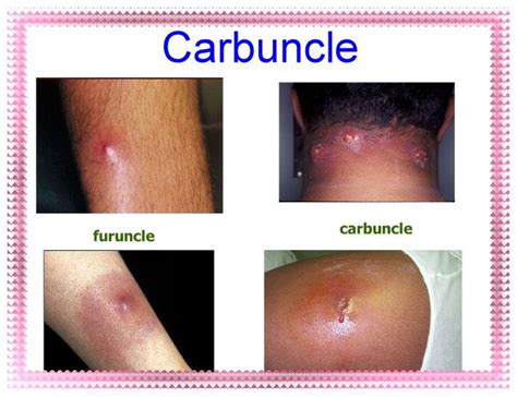 Image result for Carbuncle Definition