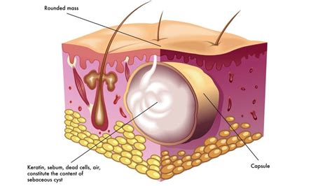 Lancing a Sebaceous Cyst に対する画像結果