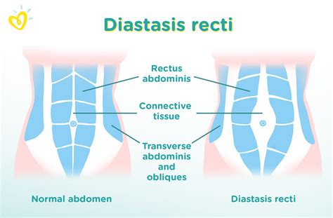 Image result for What Is Diastasis Recti in Men