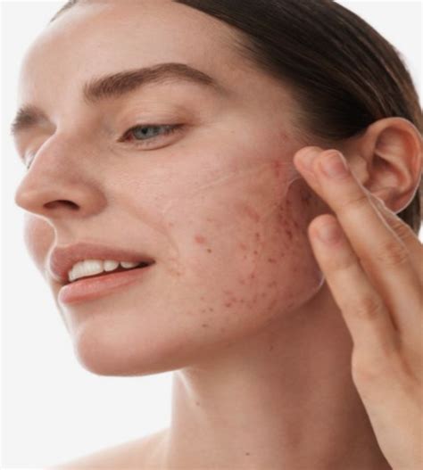 Inside Nodule Acne に対する画像結果