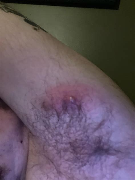Image result for Painful Pimple Under Armpit